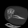 SPORK, NICO - 22.03.1976 - 02.08.2022 - CT obere Extremität - 17:51:17